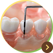 歯周病治療