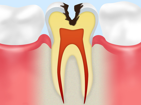 C2：象牙質に達した虫歯