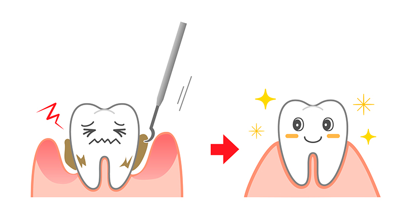歯石除去・歯のクリーニング