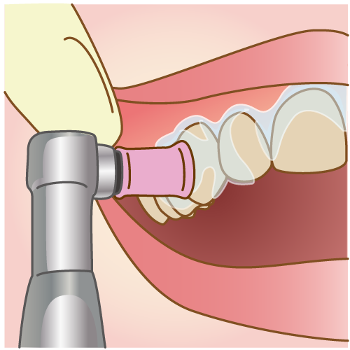 歯の表面のクリーニング