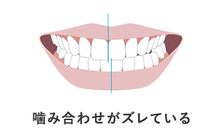 噛み合わせがズレている